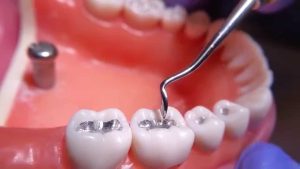 Amalgam (Silver) Fillings For Posterior Teeth: 