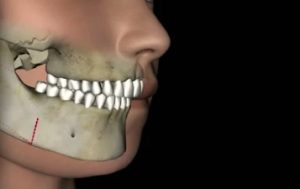  Dentofacial deformity cases