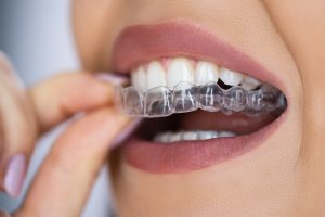 Invisible Braces (Clear Aligners)