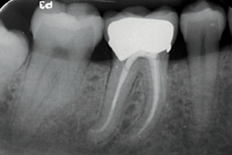 Restoration Of Endodontically Treated Teeth - Executive Dentistry