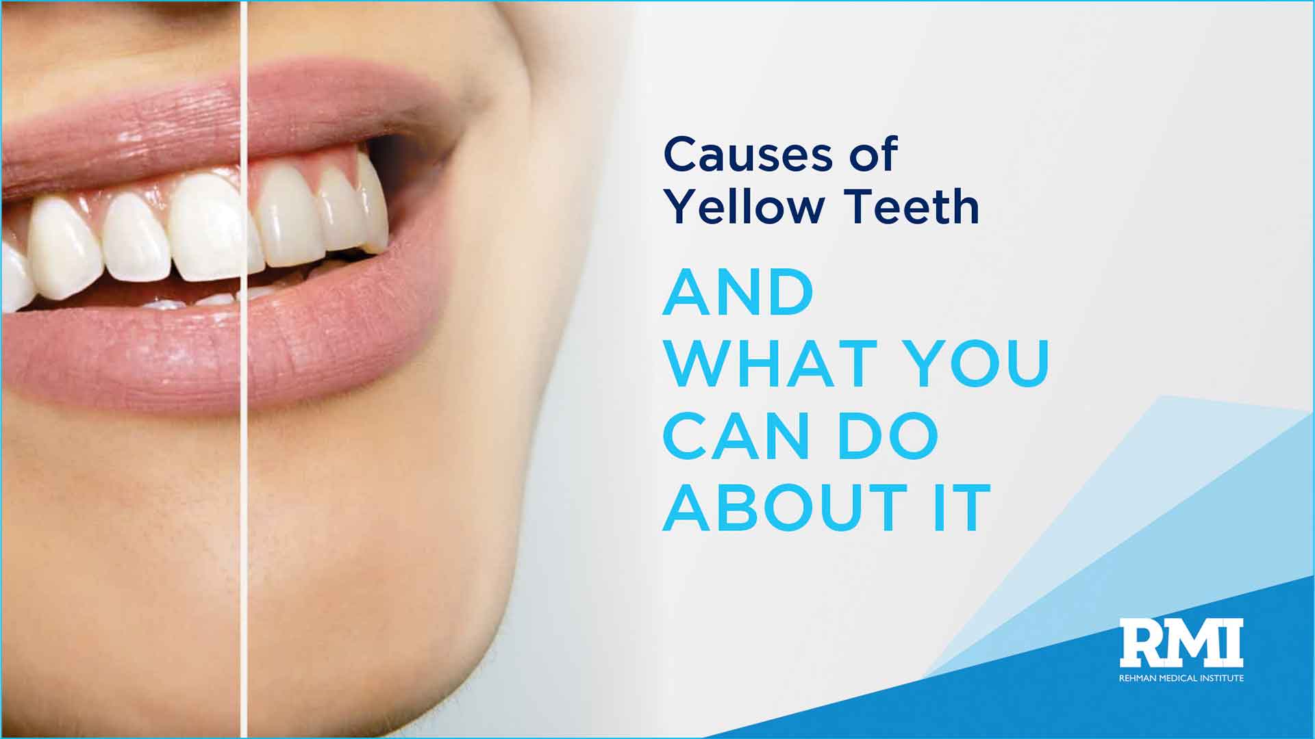 Causes of Yellow Teeth and What You Can Do About It