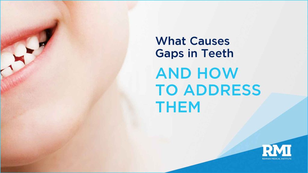 gaps in tooth