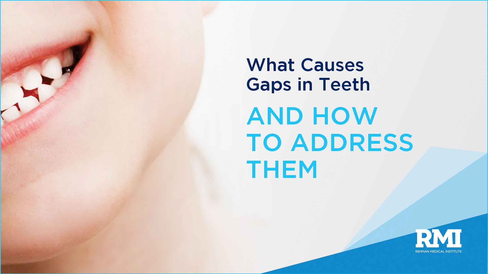 What Causes Gaps in Teeth and How to Address Them