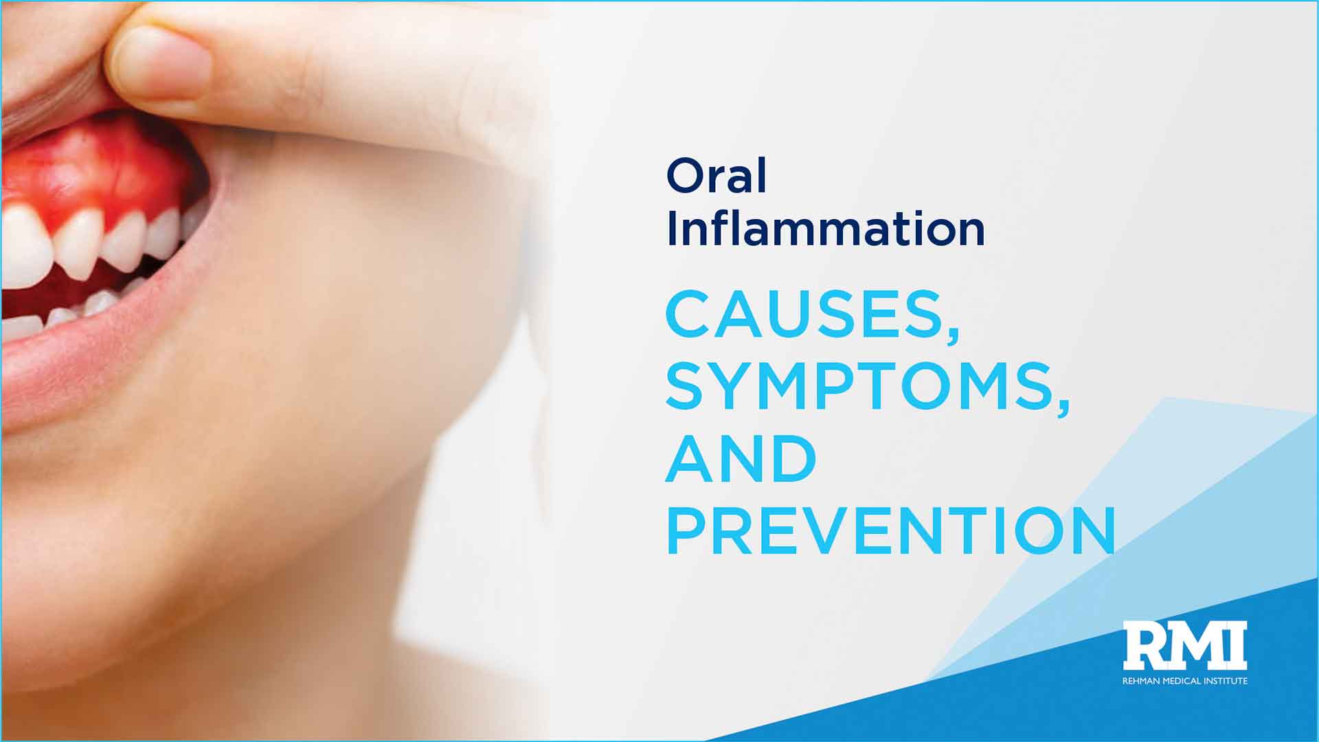 Oral Inflammation: Causes, Symptoms, and Prevention