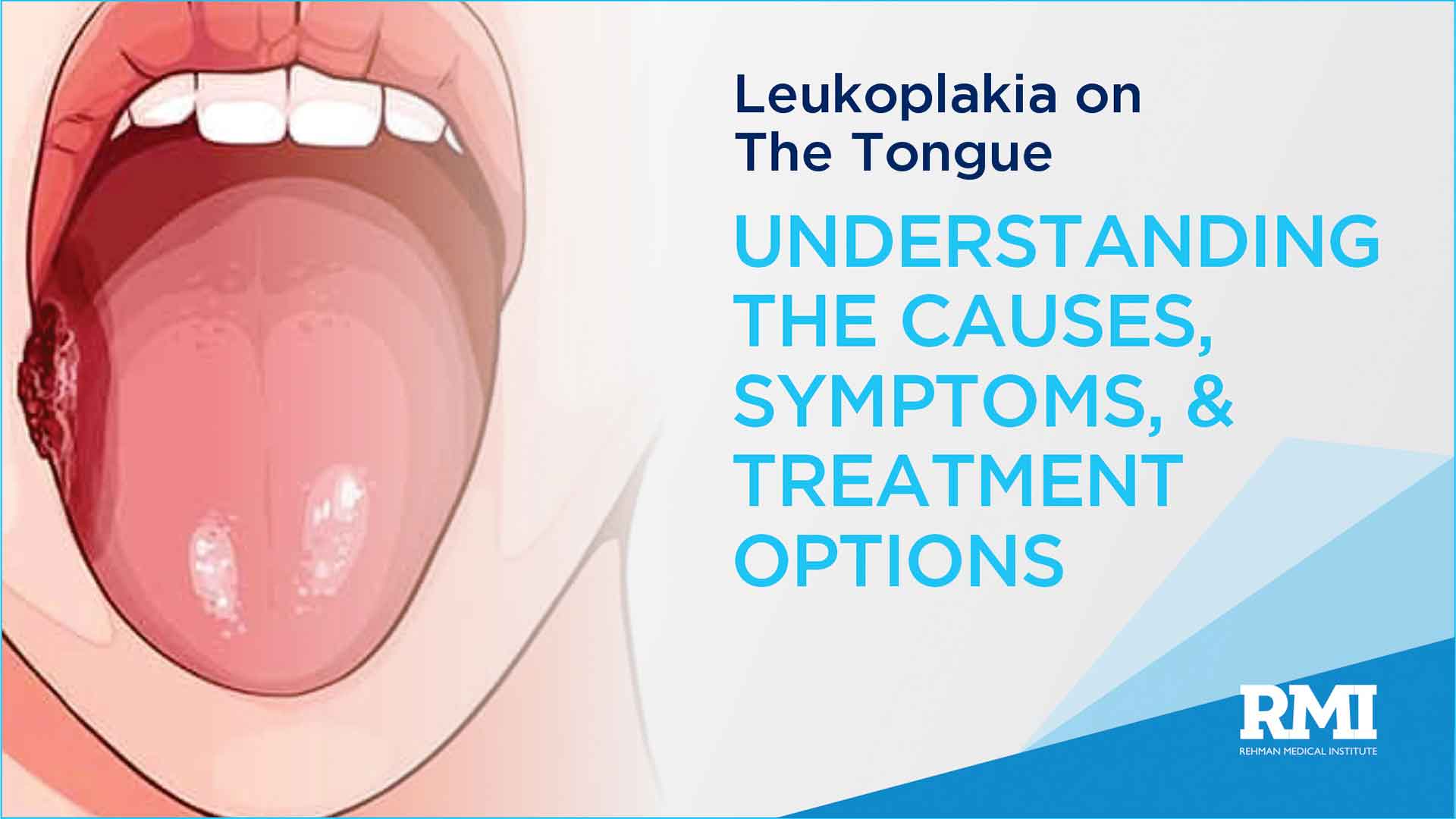 Leukoplakia on the Tongue: Understanding the Causes, Symptoms, and Treatment Options